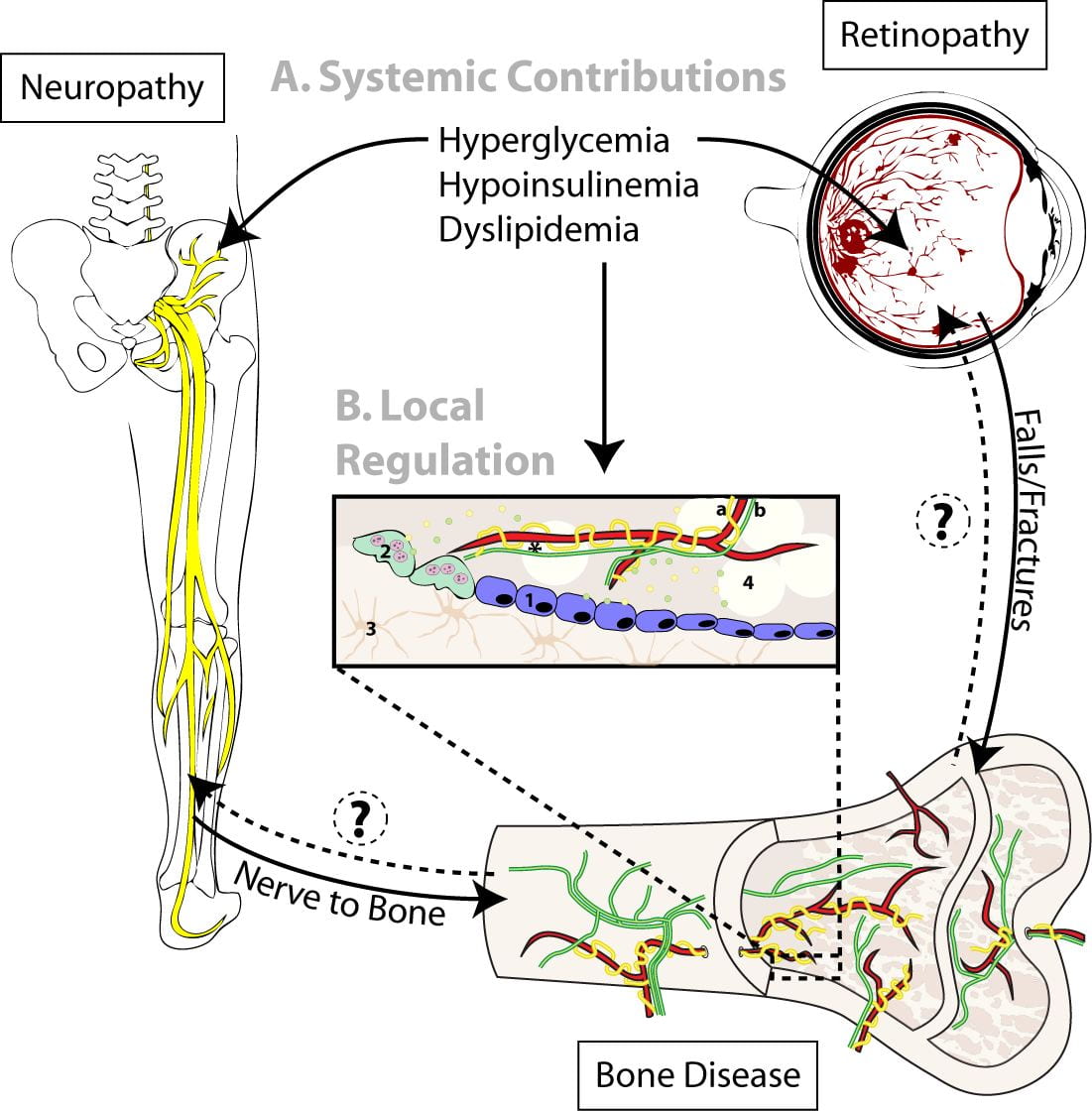 Peripheral Neuropathy as a Component of Diabetic Skeletal Disease